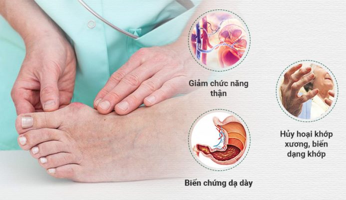 Bệnh gout có thể gây ra nhiều biến chứng nguy hiểm nếu không chữa trị kịp thời